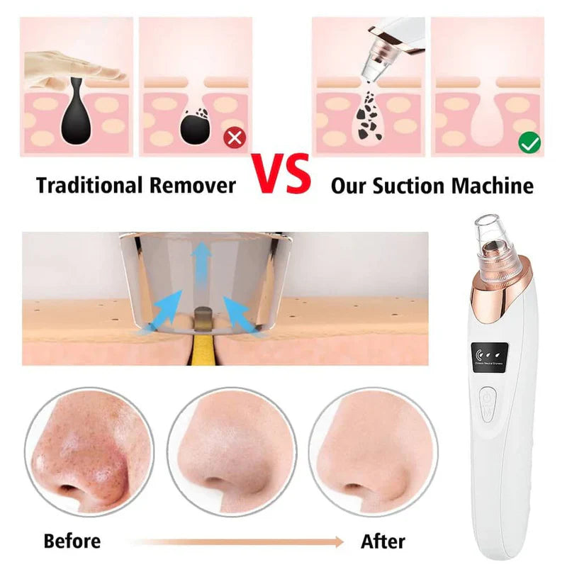 5 in 1 Rechargeable Blackhead Remover - Rechargable