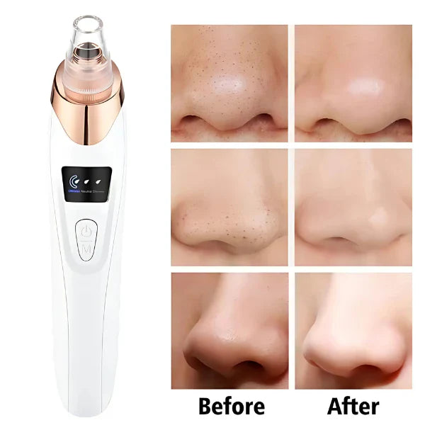 5 in 1 Rechargeable Blackhead Remover - Rechargable
